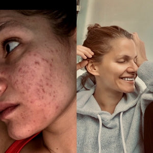 Zeolitt krem mot hudproblemer